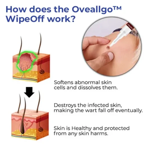 Oveallgo™ WipeOff Tags & Moles Remover